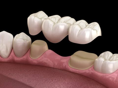 A dental bridge being seated over two prepared teeth